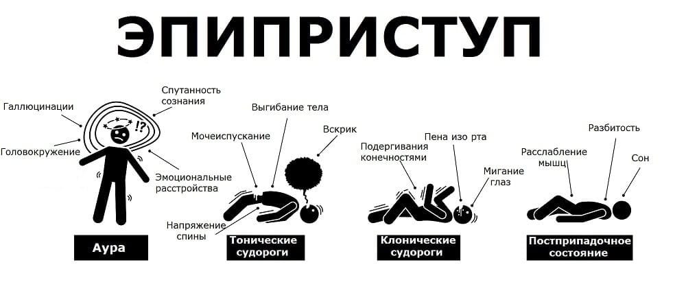 Лечение эпилепсии картинки